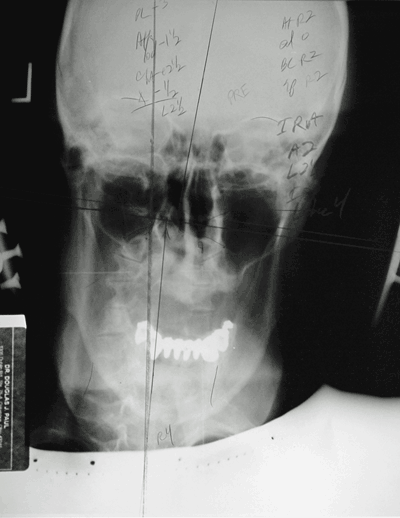 NeckXraybefore