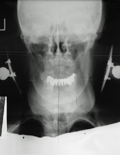 neckxrayafter