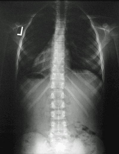 Spine After Adjustment